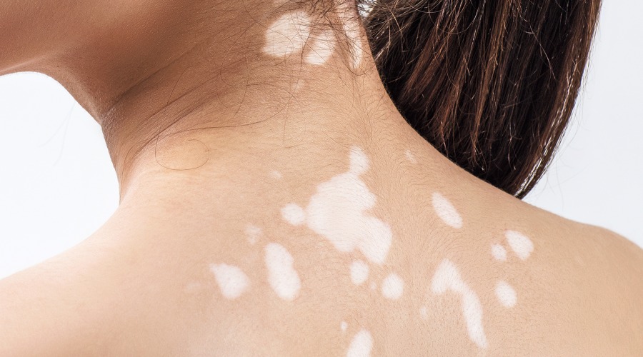 Vitiligo: Weiße Flecke auf der Haut. Foto: Kotin/Shutterstock.com