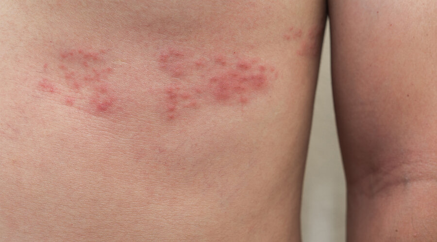 Nicht selten folgt auf eine Windpockenerkrankung der Ausbruch von Herpes zoster (Gürtelrose) Foto: TopKatai/Shutterstock.com