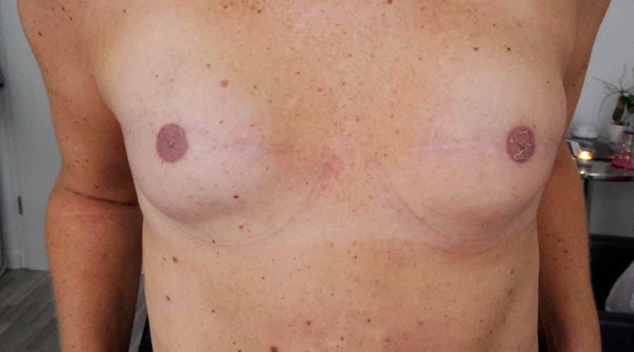 Brüste nach der letzten PMU-Behandlung, fast abgeheilt. Fotos: Autorin