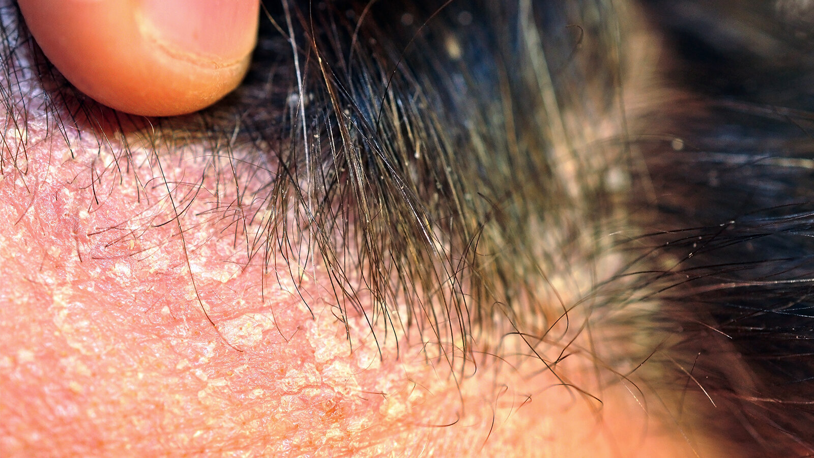 Seborrhoisches Ekzem Kruste Schuppen Kopfhaut www.beauty-forum.com