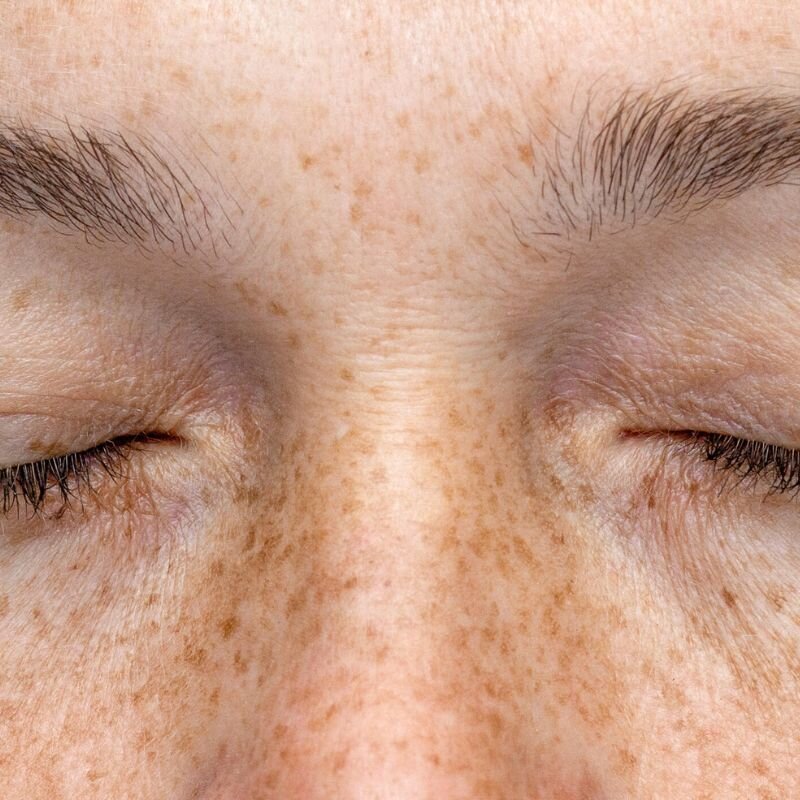 Sommersprossen im Gesicht
