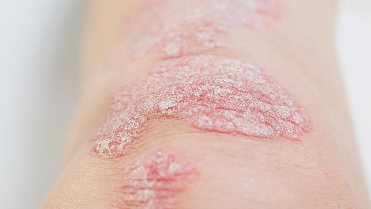 Foto: Psoriasis_SNAB/Shutterstock.com