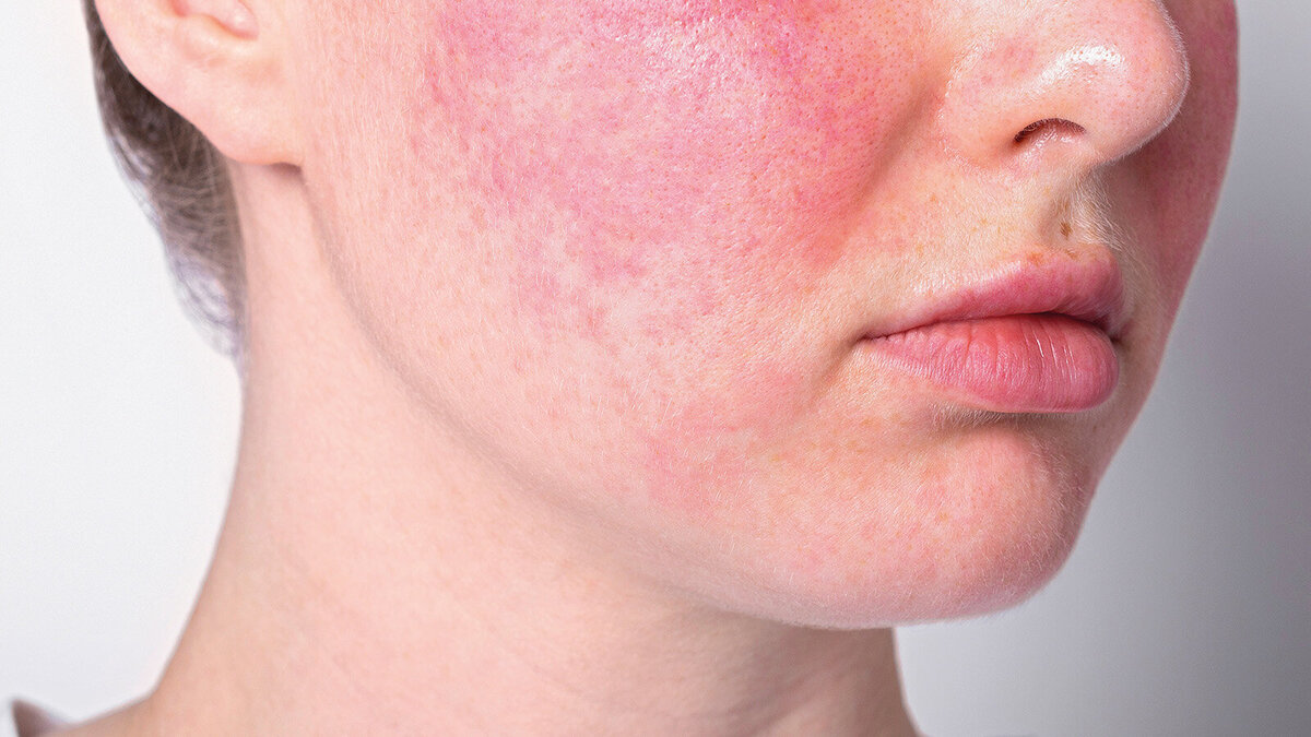 Foto: Rosacea_iso100production/Shutterstock.com