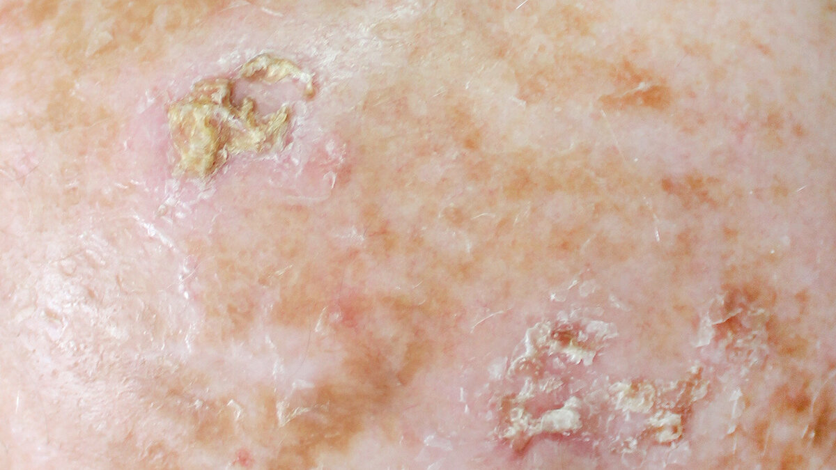 Foto: Dermatology11/Shutterstock.com