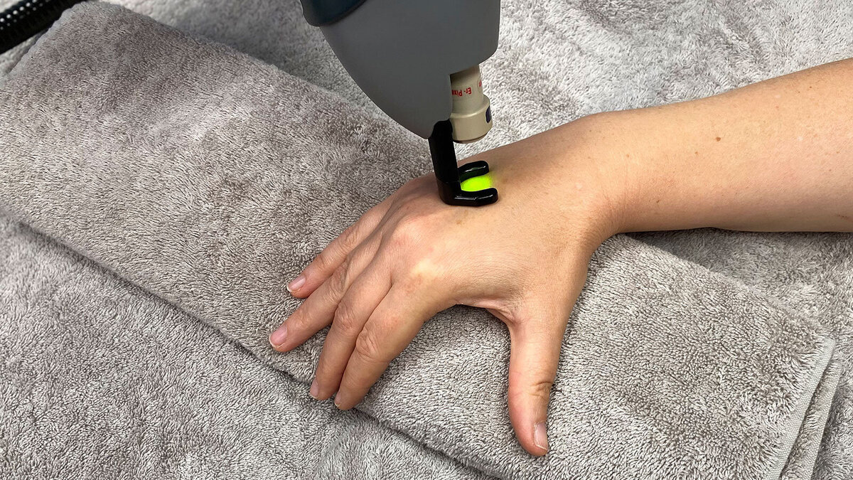 Laser Hautverjüngung