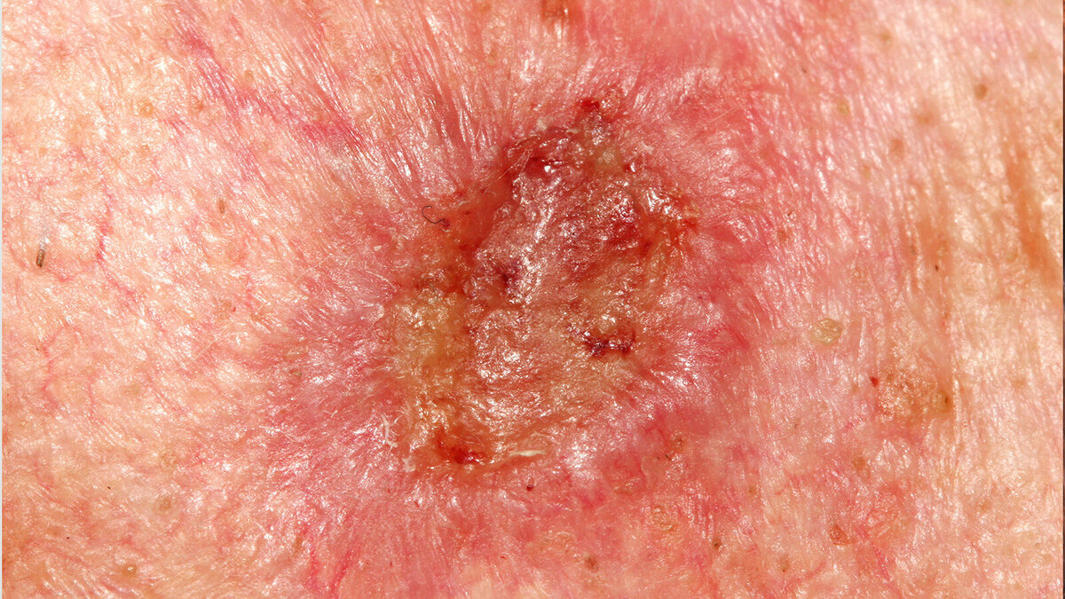 Foto: Dermatology11/Shutterstock.com