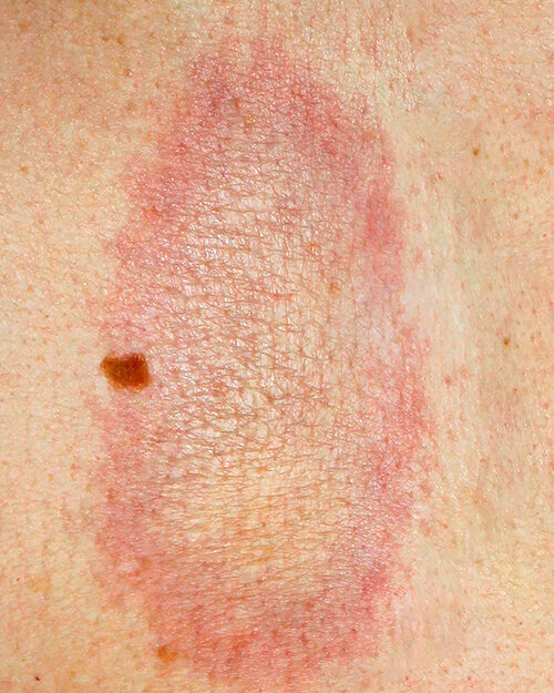 Fotos: Dermatology11/Shutterstock.com