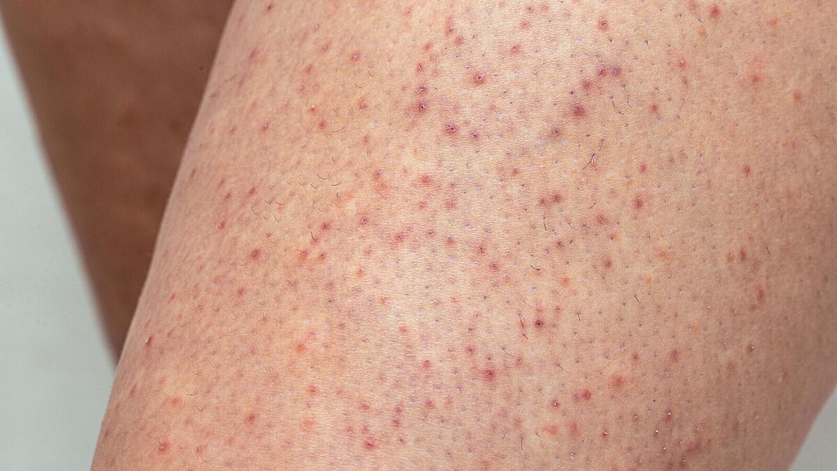 Aufmacher-Keratosis-pilaris