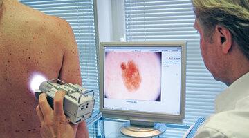 Videoauflichtmikroskopische Untersuchung von Pigmentmalen und auffälligen Hautveränderungen. Foto: Autor 
