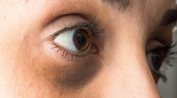 Bei Augenringen spricht man auch von „halonierten“ Augen. Das Wort kommt vom griechischen Wort „halos“(für Lichthof oder Hof). Foto: sruilk/Shutterstock.com, Skizzen: Autorin