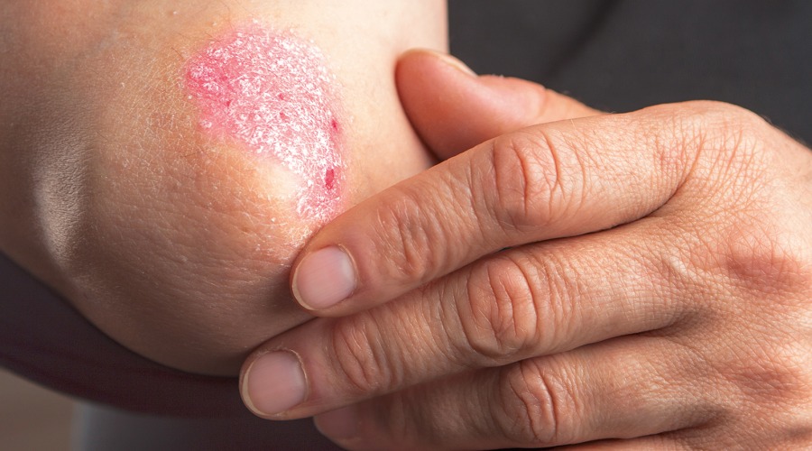 Schuppenflechte zeigt sich meist mit grober, silbriger Schuppung auf geröteter Haut an den Gelenkaußenseiten. Foto: Hriana / Shutterstock.com
