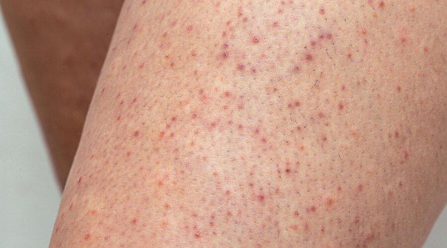 Aufmacher-Keratosis-pilaris