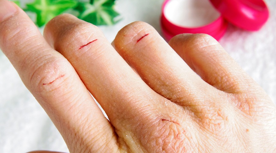 In der kalten Winterzeit wird die Haut an dr Hand oft rot, rau und rissig. Gezielte Pflege ist in diesen Monaten Gold wert. Foto: Emi-s/Shutterstock.com
