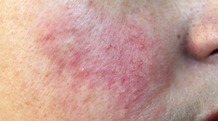 Ist das gesunde Mikrobiom der Haut gestört, kann es zu entzündlichen Hauterkrankungen wie Rosacea kommen. Foto: Dermatology11/Shutterstock.com