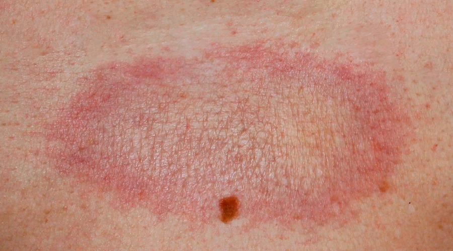 Sklerodermie in Plaque-Form. Fotos: Dermatology11/Shutterstock.com, Autorin