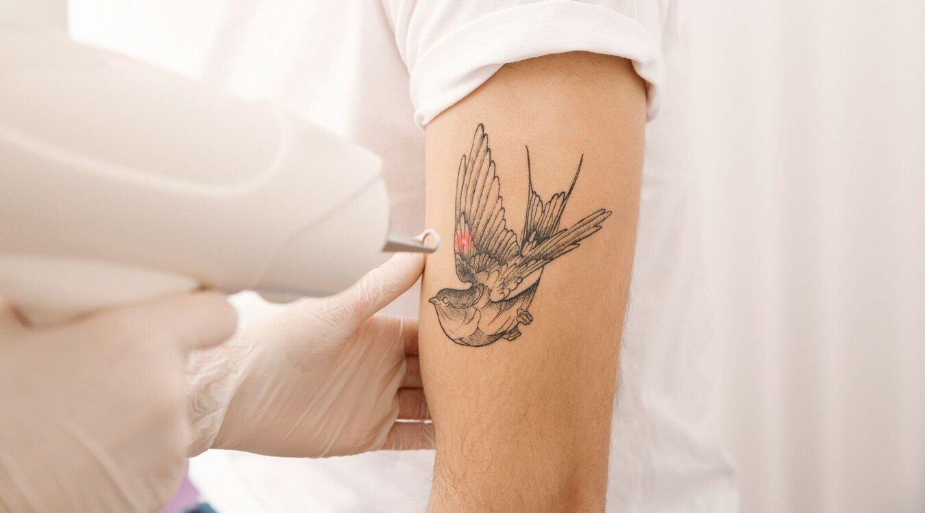 Laser versus Tattoo