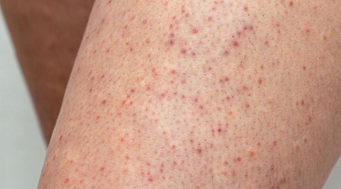 Aufmacher-Keratosis-pilaris